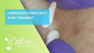 Compilation of Christian’s Acne Treatment