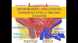 HEMOROİDİN AMELİYATSIZ DAMAR İÇİ YOLLA TEDAVİSİ