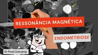 Ressonância magnética na endometriose