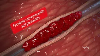 D-Clot HD Mechanical Thrombectomy System