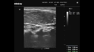 Видеозапись УЗИ - Определение длины доли в три фрагмента