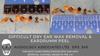 DIFFICULT DRY EAR WAX REMOVAL & EARDRUM PEEL - EP340