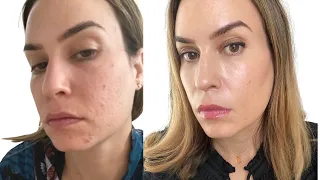 What is causing my acne? - Holistic approach without Accutane, diet or meds!