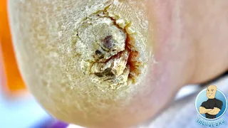 THE BIGGEST FOOT WART EVER??? ***PLANTAR WART REMOVAL SURGERY***
