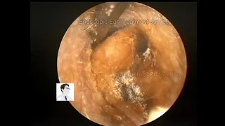 ear wax removing ,Severe cerumen embolism prosessing