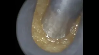 11 - Glue Ear Wax Removal with WAXscope®️