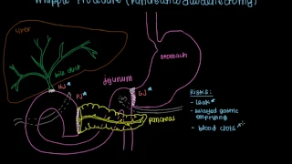 Whipple Procedure (Pancreaticoduodenectomy)