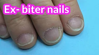 Nail Transformation of Ex- Biter With Hard Gel on Forms
