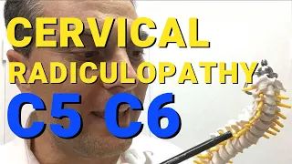 What Is C5 C6 Radiculopathy? What Causes Cervical Radiculopathy? Dr Walter Salubro