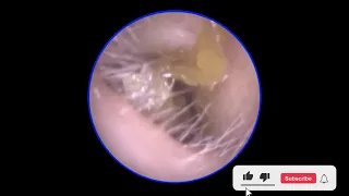 Most Challenging Eardrum Skin Peel