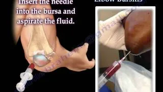 Aspiration Of Elbow Bursitis - Everything You Need To Know - Dr. Nabil Ebraheim