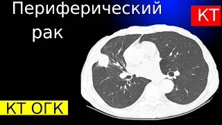 Лучевая диагностика периферического рака легкого