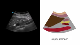 Assessing the stomach for NPO status