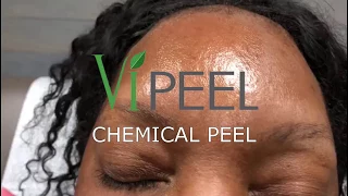 VI Peel * Chemical Peel