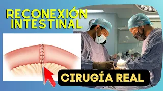 🎥 ¿CÓMO ES una cirugía de 𝗥𝗘𝗖𝗢𝗡𝗘𝗫𝗜𝗢́𝗡? Explicación a detalle (Imágenes explicitas)