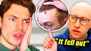 Plastic Surgeon DISMANTLES My Hair Transplant (My Reaction)