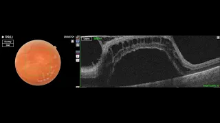 Extreme vitreomacular traction syndrome (VMTS)