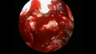 SUPERIOR ORBITAL FISSURE AND ORBITAL APEX LESION -ENDOSCOPIC RESECTION