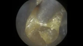 94 - Large Ear Wax Plugs Removal using WAXscope®️