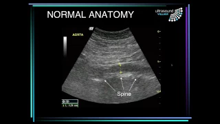 Abdominal aortic aneurysm ultrasound
