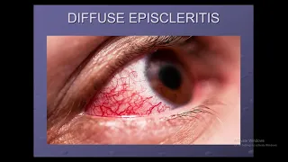Episcleritis & scleritis