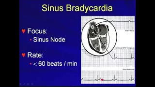 5.1.b. Sinus Bradycardia - Bradyarrhythmias [Hong Kong University]