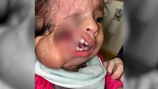 NYC doctors perform life-changing surgery for 3-year-old girl