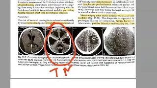 Pediatrics 569 Tuberculous meningitis Rich foci HYDROCEPHALUS Tuberculosis child