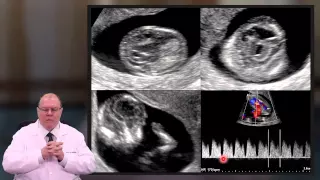 Vídeo Blog - Ultrassonografia Morfológica do Primeiro Trimestre: Diagnóstico Precoce de Malformações