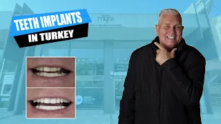 Teeth Implants in Turkey Review 2022 | IS IT WORTH IT? #veneersturkey #teethturkey #implantsturkey