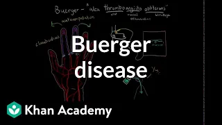 Buerger disease | Circulatory System and Disease | NCLEX-RN | Khan Academy