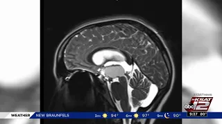 San Antonio student’s headaches help doctors find tumor in her brain