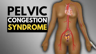 What Is Pelvic Congestion Syndrome?