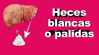 Las Heces Blancas o Pálidas son PELIGROSAS ¿Debería preocuparme?