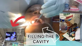 Dentist Filling A Cavity Between Teeth🦷|| What you should know when you visit the dentist|| #health
