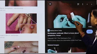 Monkeypox को Diagnosis