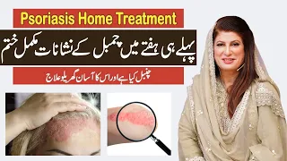 Psoriasis Treatment by Dr. Bilquis | Chambal ka Ilaaj | چنبل کی بیماری کا علاج