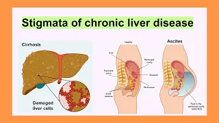 stigmata of chronic liver disease
