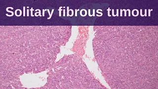 Solitary Fibrous Tumour - Pathology mini tutorial