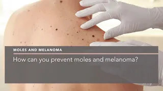 How can you prevent moles and melanoma?
