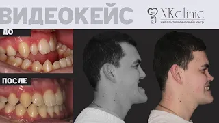 Ортогнатическая операция на челюсти. Исправление мезиального прикуса в NKclinic