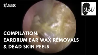 558 - COMPILATION: Eardrum Ear Wax Removals & Dead Skin Peels