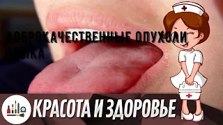 Доброкачественные опухоли языка