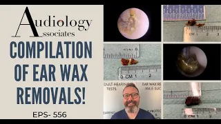 EAR WAX REMOVALS FROM TODAYS CLINIC - EP556