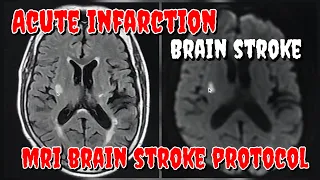Acute Infarction in MRI Brain || MRI Brain Stroke Protocol || DWI / ADC Images || MRI Brain Findings