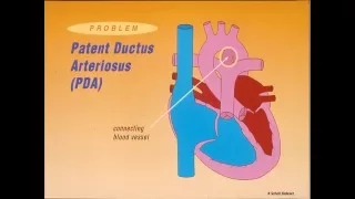 20160510 Congenital Heart Disease and Anesthesia: Foundational Concepts