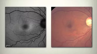 Retina and Systemic Disease Part 3