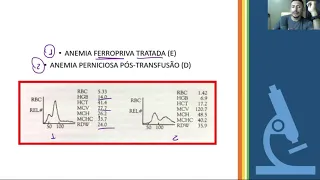 Interpretação do Hemograma - Tipos de Anemias com Histograma