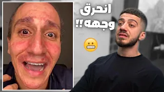 حرق وجهه عشان دعم بالبث