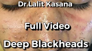 Deep Blackhead Removal FULL VIDEO by Dr.Lalit Kasana